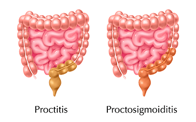 Proctitis: ¿qué es y cómo se trata?